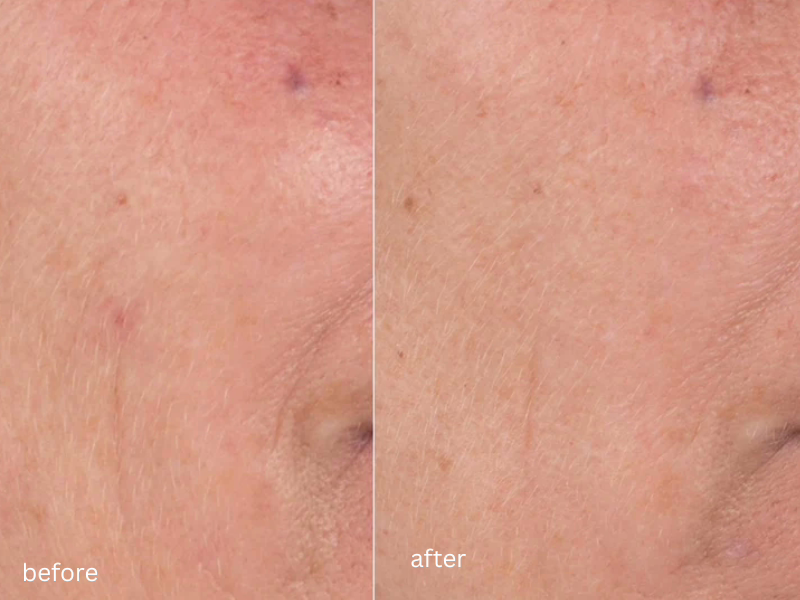 Before And After An Advanced Skin Treatment 2 Before And After An Advanced Skin Treatment 2